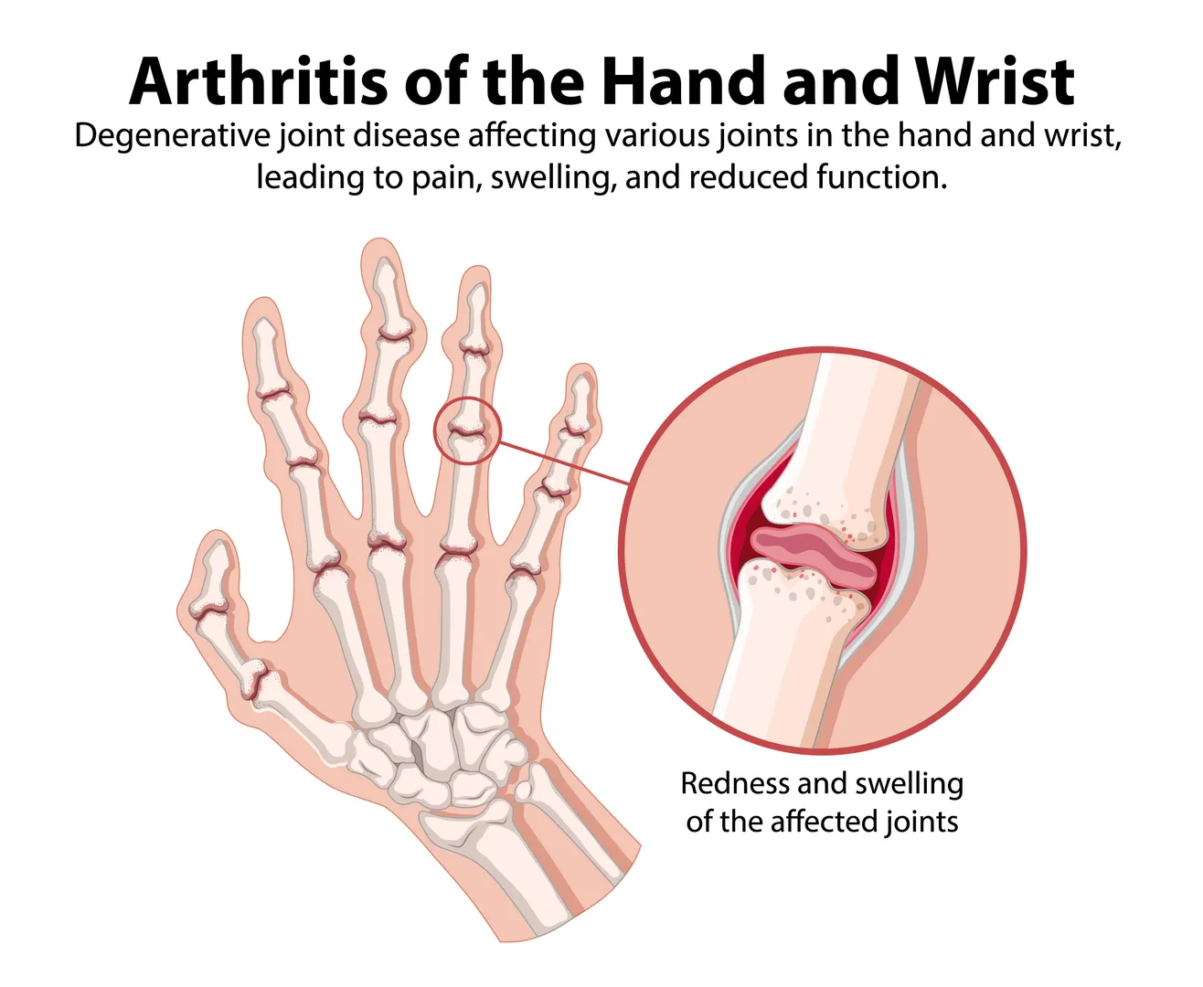 Arthritis of the Hand Treatment in Matunga – Managing Stiffness and Pain