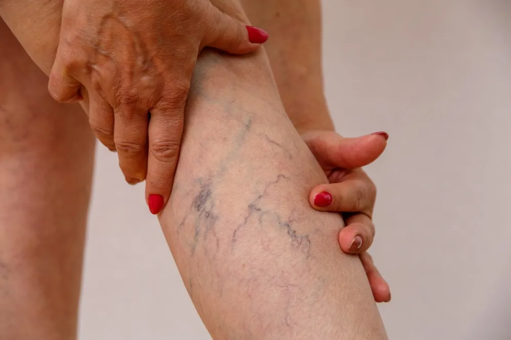 Varicose Veins Laser Surgery Specialist in Chembur Moving Towards Pain-Free Legs