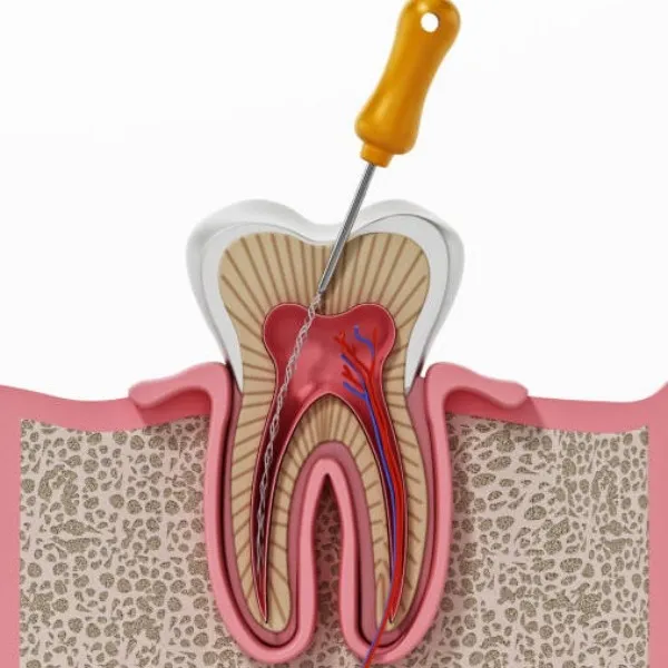 Root canal Treatment In Vashi
