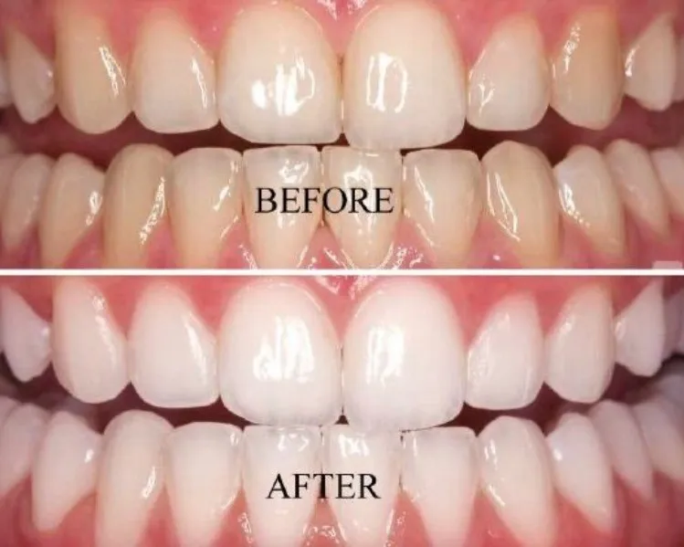 How Much Does Teeth Whitening Cost in Thane (Nitin Company Area)? A Complete Patient Guide