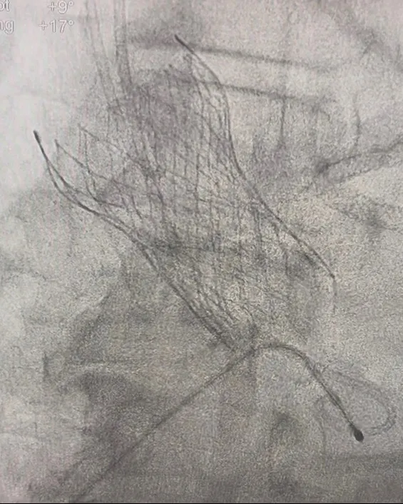 π Advanced TAVI/TAVR Treatment in Panvel | Minimally Invasive Heart Valve Replacement