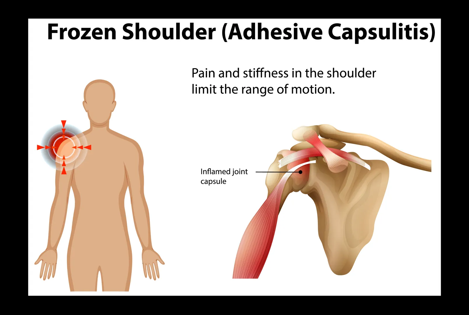 Frozen Shoulder Treatment in Nagarbhavi – Restoring Shoulder Mobility