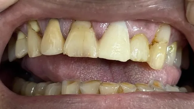 Is Gum Treatment Painful? Dentist in Mulund West Mumbai Explains the Truth