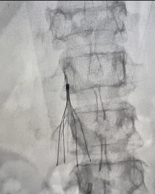 IVC Filter: Simple Guide