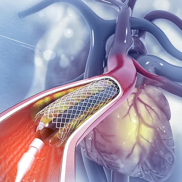 Best Angioplasty hospital in Pune