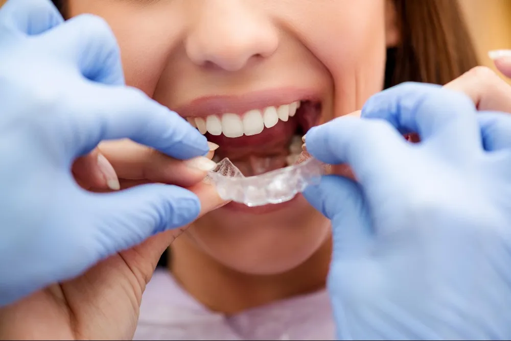 Invisalign and Clear Aligners Dentist in Dwarka Straightening Teeth Without the Usual Hassle