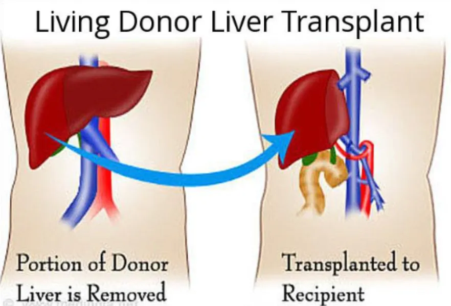 Living Donor Liver Transplant In Pune – A Life Saving Path When Every Moment Matters