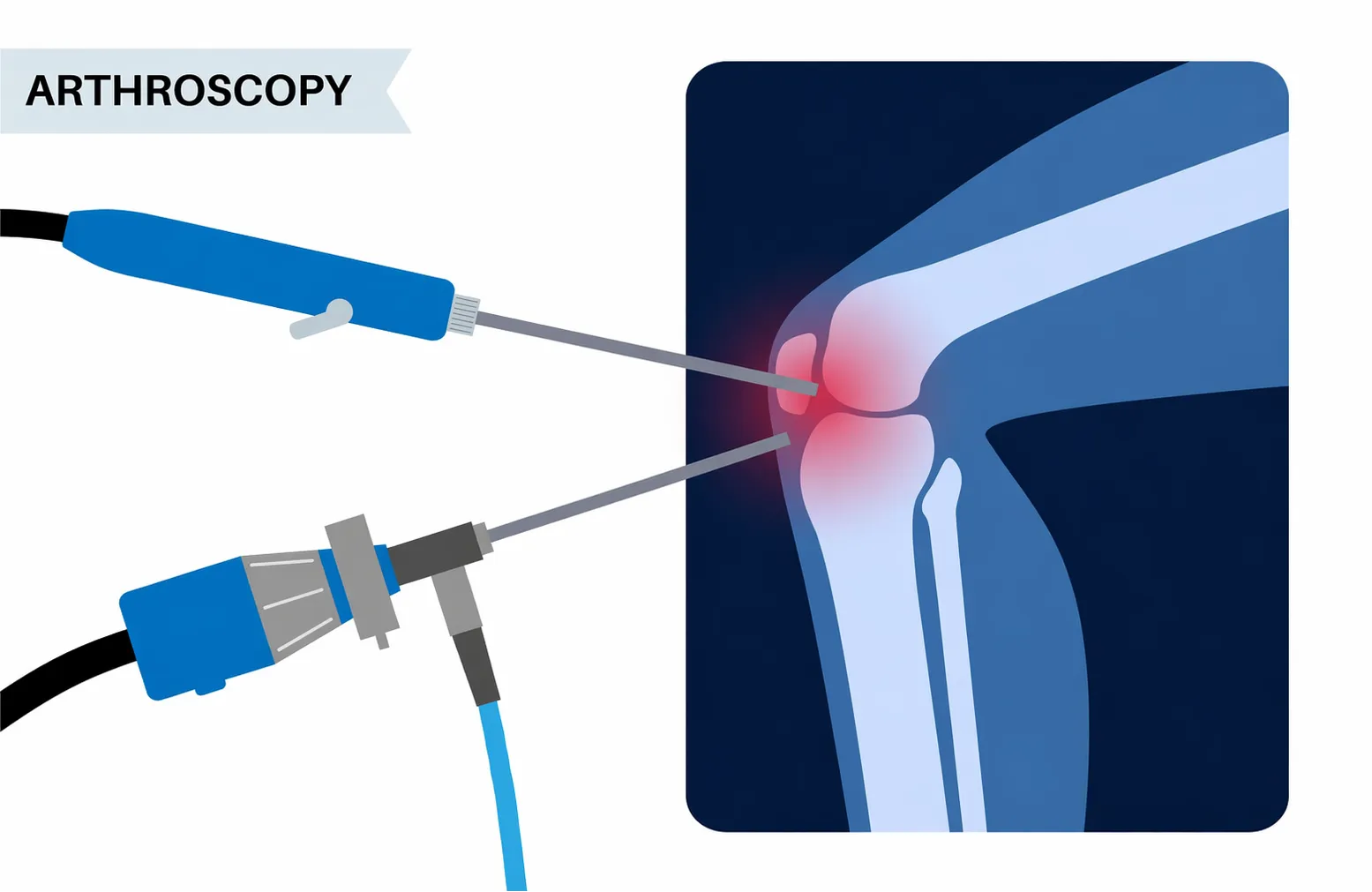 Arthroscopy ACL Reconstruction in Nagarbhavi – Treating Ligament Injuries with Precision