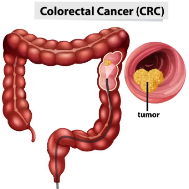 Colon Cancer Screening in Mumbai Importance of Early Detection and Prevention
