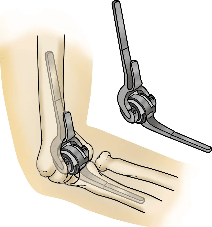 Best Orthopedic Surgeon for Elbow Replacement in Pitampura