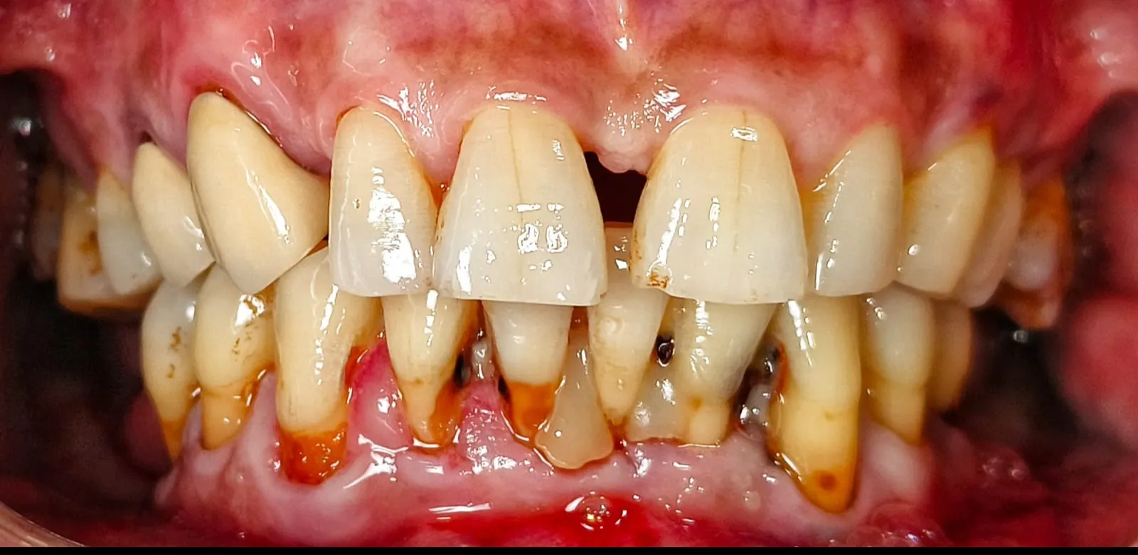 How Long Does Gum Treatment Take? Timeline Explained by Dentists in Thane (Nitin Company Area)