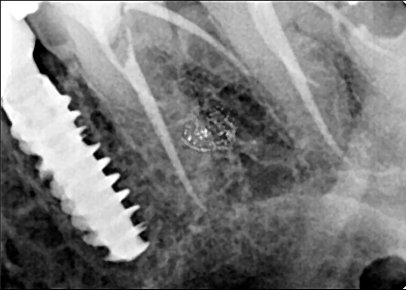 Root Canal Treatment vs Alternatives: What Dentists in Thane (Nitin Company Area) Recommend