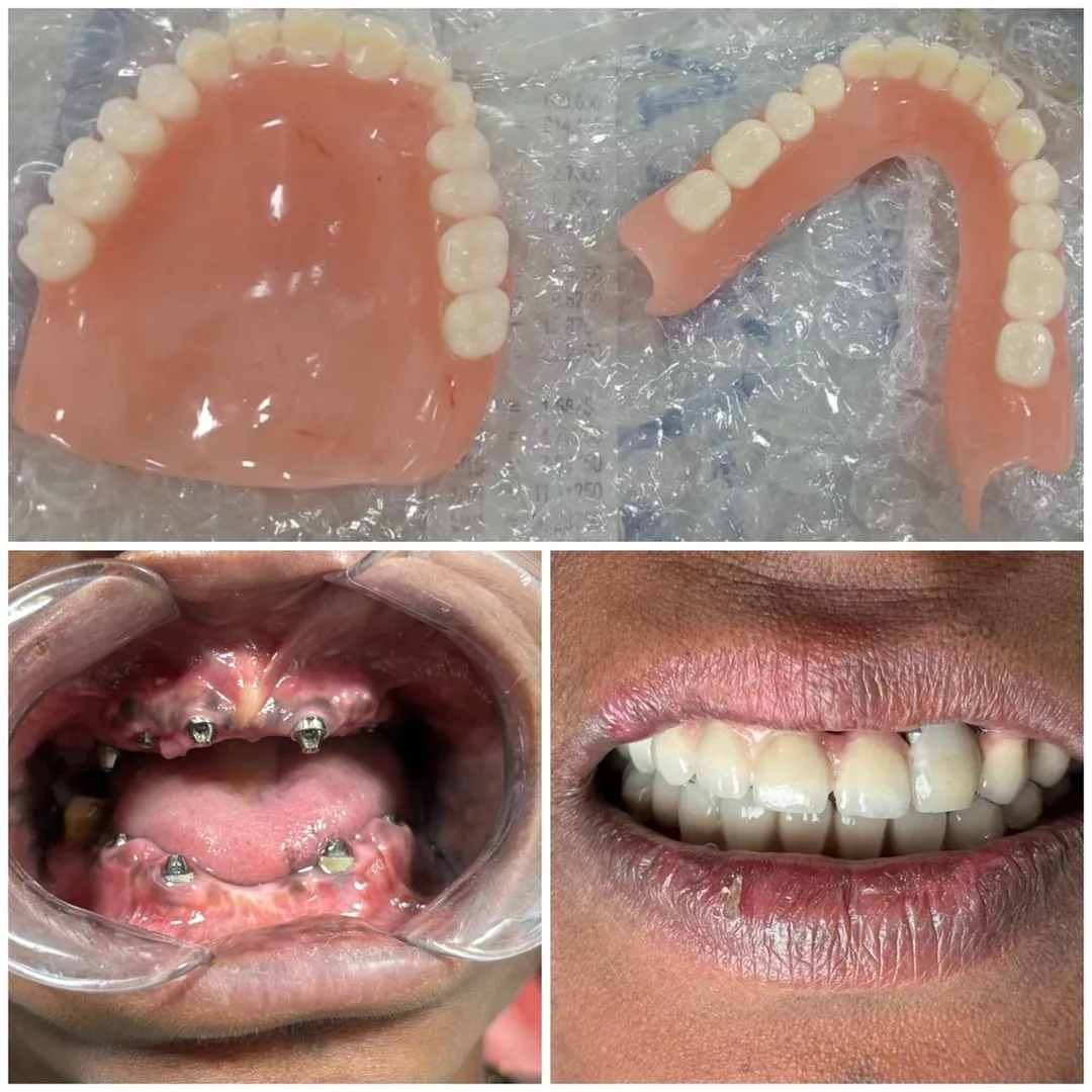 Full Mouth Rehabilitation vs Alternatives: What Dentists in Mulund West Mumbai Recommend