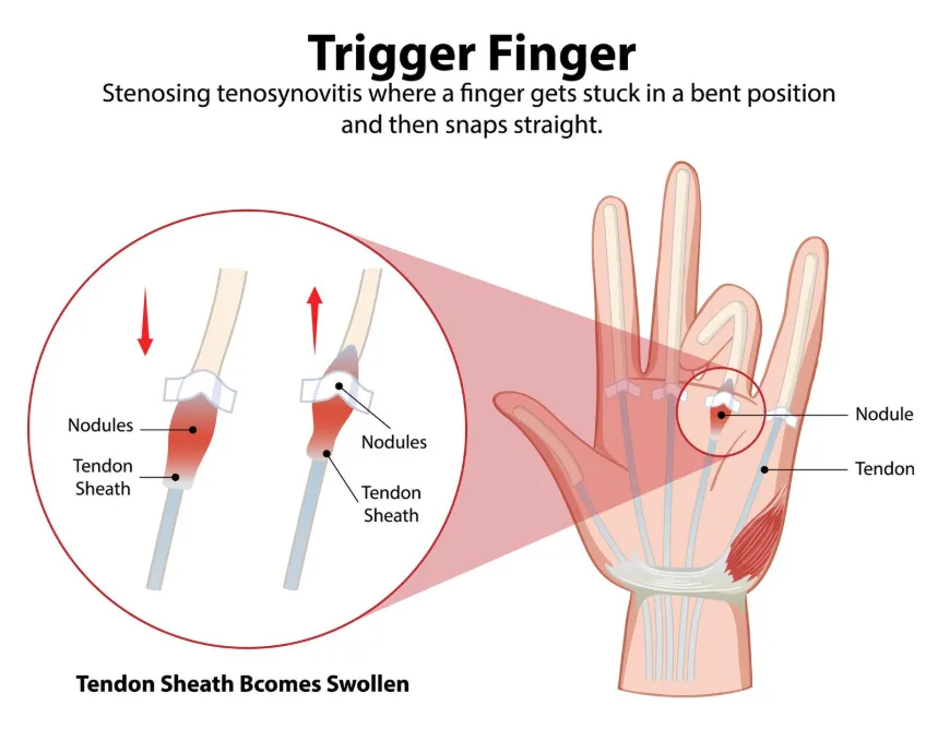 Trigger Finger Treatment in Chembur – Restoring Smooth Finger Movement