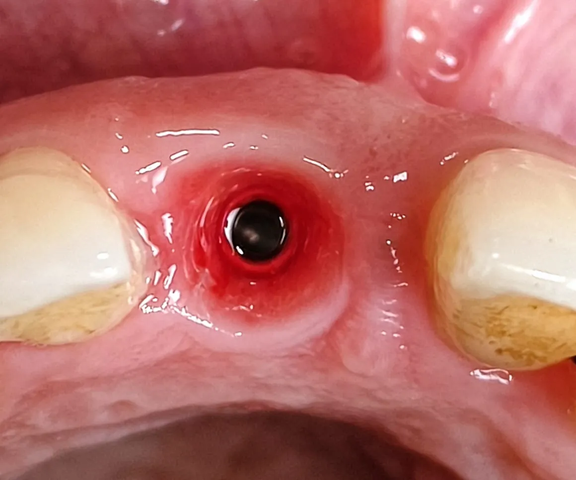 Best Dentist for Dental Implants in Thane (Nitin Company Area): What to Expect During Treatment