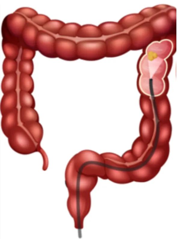 Colonic Polyps Treatment in Mumbai Detecting Early Changes Before They Become Serious