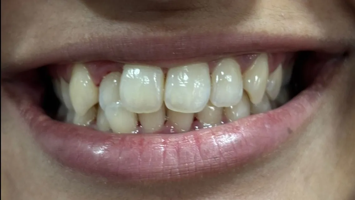 How Much Does Teeth Whitening Cost in Mulund West Mumbai? A Complete Patient Guide