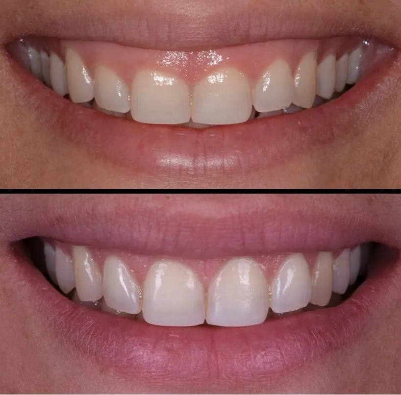 Laser Dentistry in Thane (Nitin Company Area): Before, During & After Treatment Guide