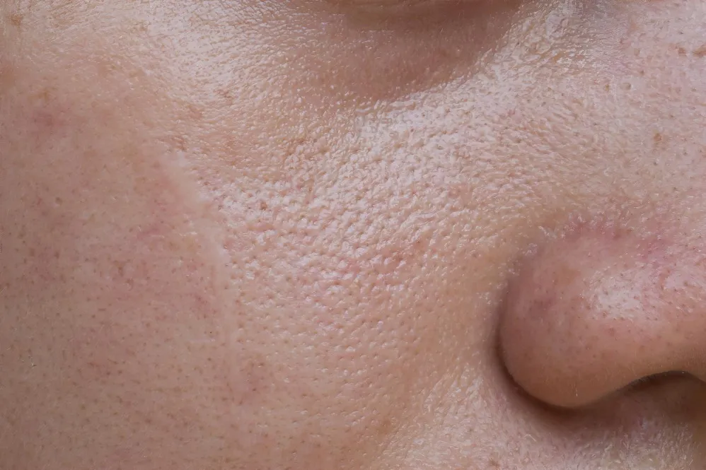 Open Pores Treatment in Chennai | Smooth, Refined Skin Awaits
