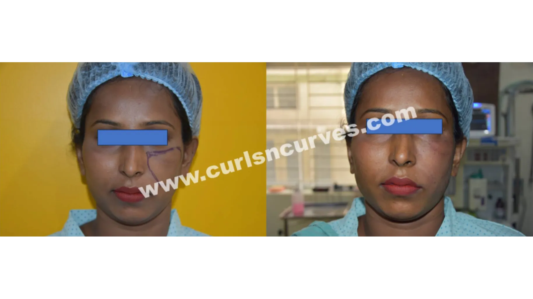 Fat Grafting Surgery in Bengaluru for Natural Volume Enhancement