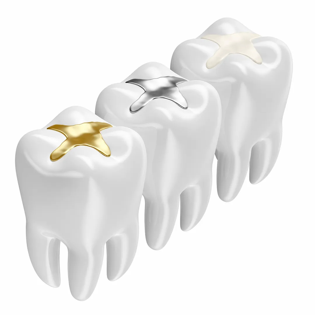 Tooth Fillings in Sarjapur Road for Treating Cavities Before They Worsen