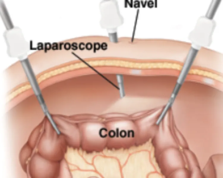 Laparoscopic Colon Surgery in Thane – Advanced Care for Digestive Health Conditions