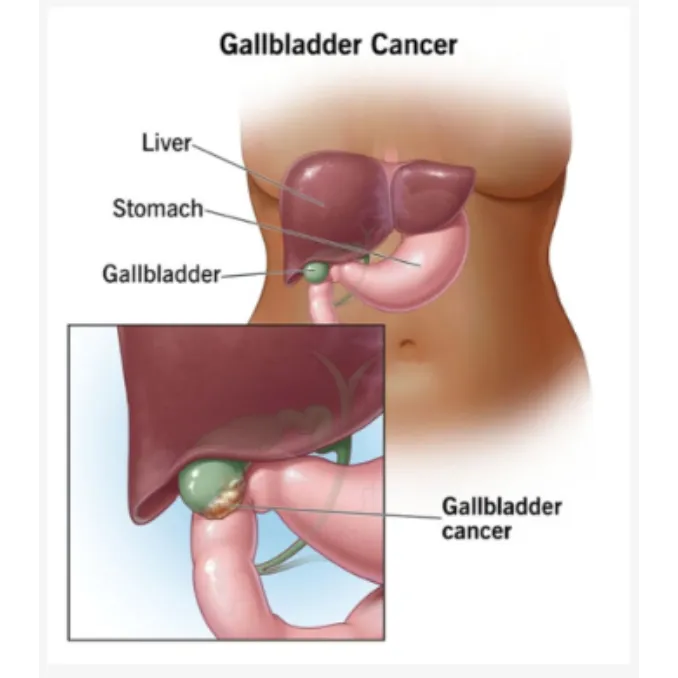 Gallbladder Cancer Treatment Specialist in PCMC – Recognising Early Signs for Better Outcomes