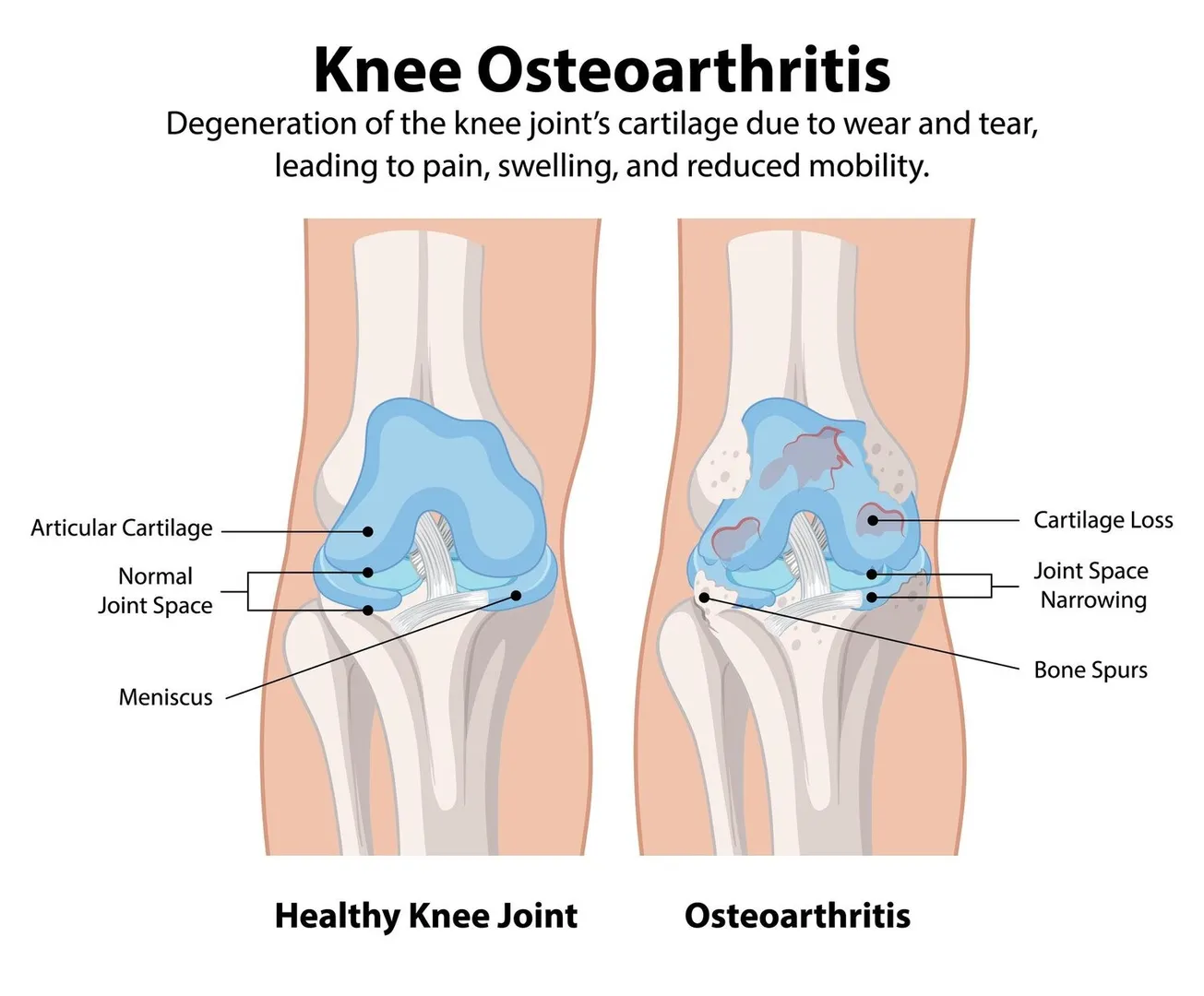 Osteoarthritis Knee Treatment in Rohini Sector 16