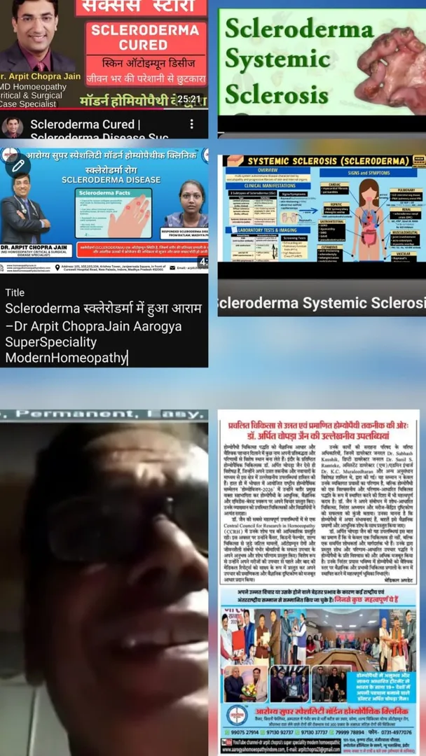 Scleroderma स्क्लेरोडर्मा में हुआ आराम –Dr Arpit Chopra Jain Aarogya Super Speciality Modern Homeopa...