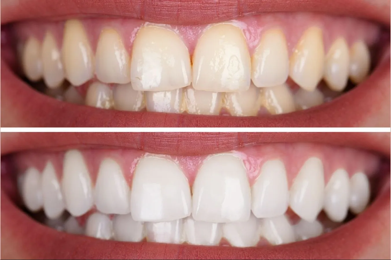 How Long Does Teeth Whitening Take? Timeline Explained by Dentists in Mulund West Mumbai