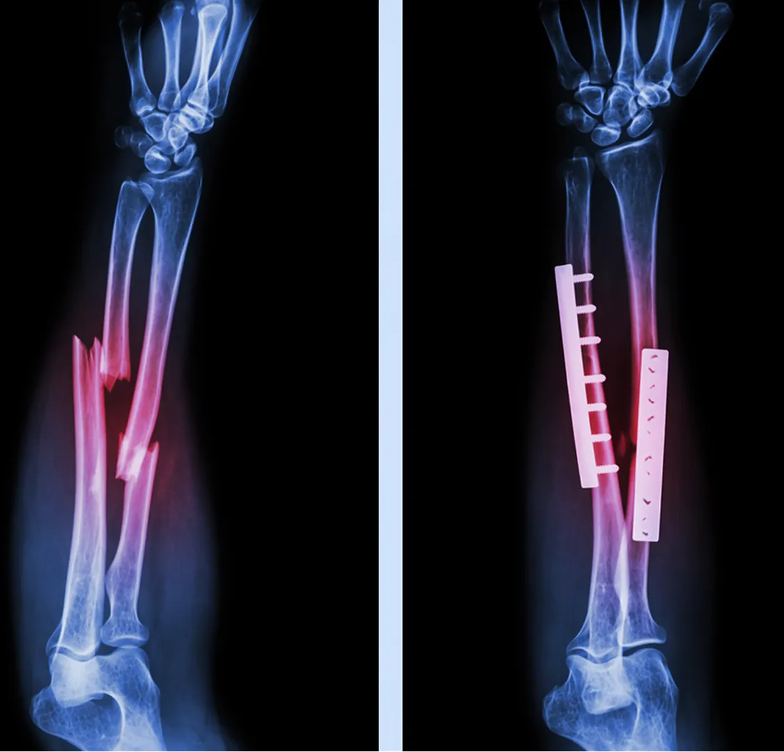 Nonunion and Malunion Fracture Treatment in Moshi – Addressing Fractures That Do Not Heal Properly