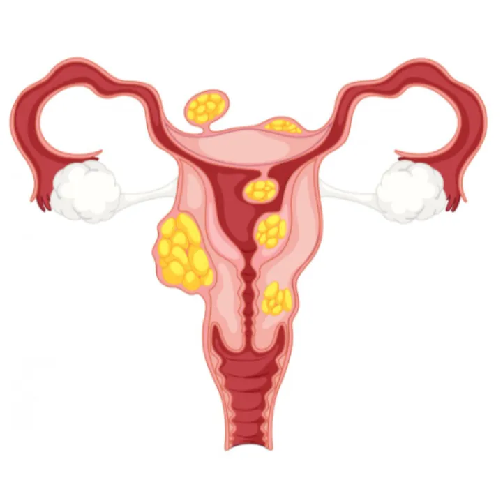 Endometriosis Treatment Specialist in Thane – Alleviating the Pain of Endometriosis