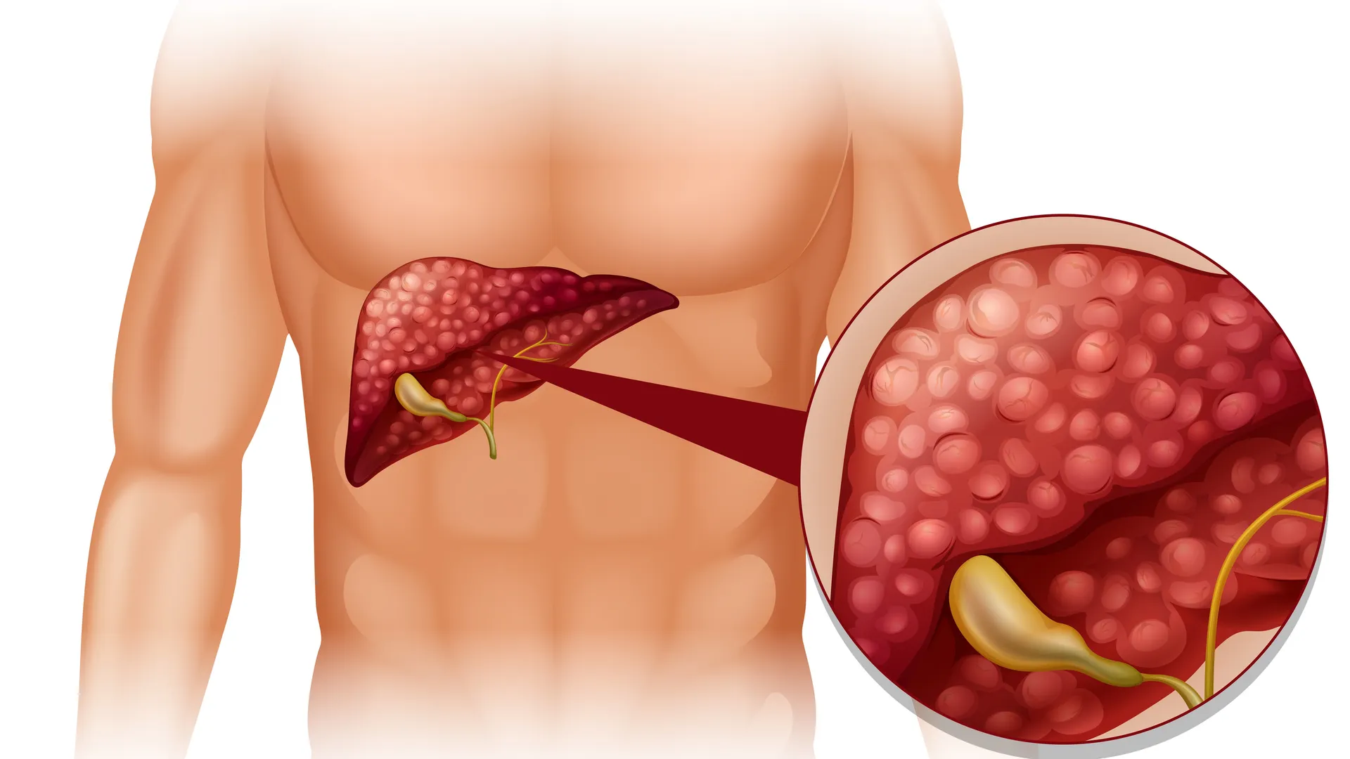 Hydatid Cyst Removal Surgery in Mumbai Safe Treatment for Parasitic Cyst Conditions