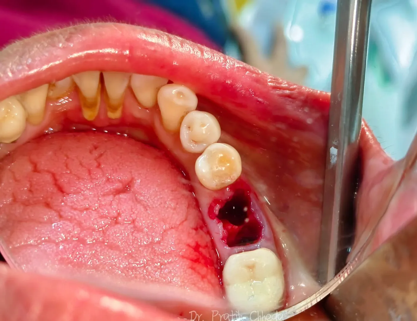 Is Tooth Extraction Painful? Dentist in Thane (Nitin Company Area) Explains the Truth