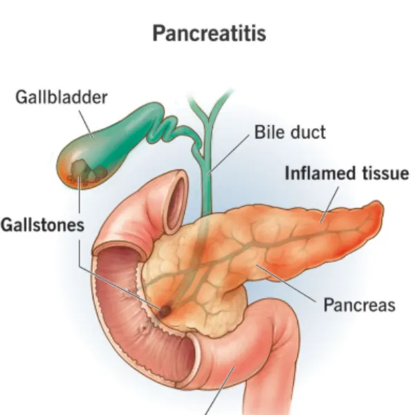 Pancreatitis Treatment Specialist in PCMC – Managing Sudden Pain with the Right Care Approach