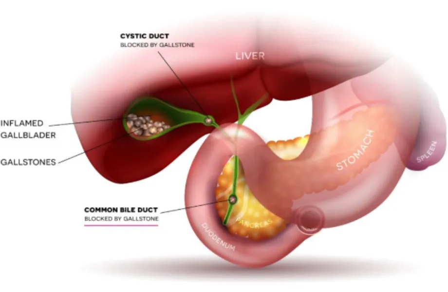 Bile Duct Stones Treatment Specialist in PCMC – Restoring Flow and Relieving Hidden Discomfort