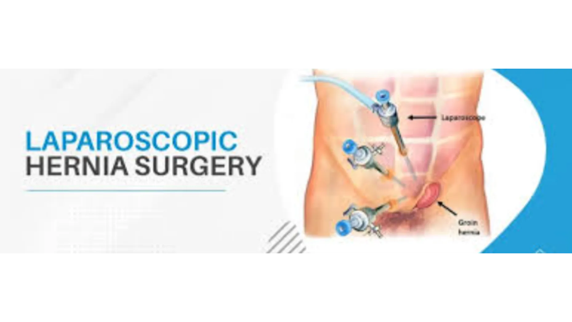 Hernia Treatment in Goregaon