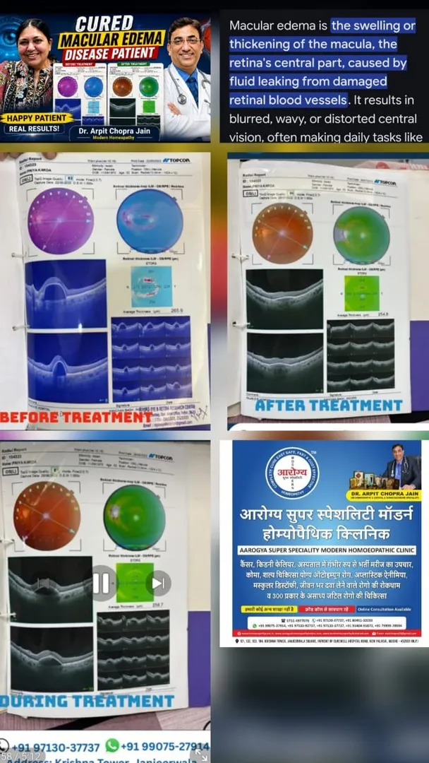 Macular Edema मैकुलर एडिमा Eye vision Blurred आँखों की समस्या हुई ठीक - Dr Arpit Chopra Jain Aarogya...