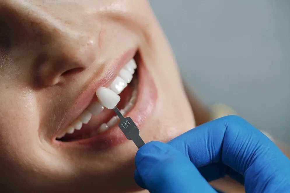 Dental Veneers in Nashik – Transform Your Smile with Natural-Looking Results