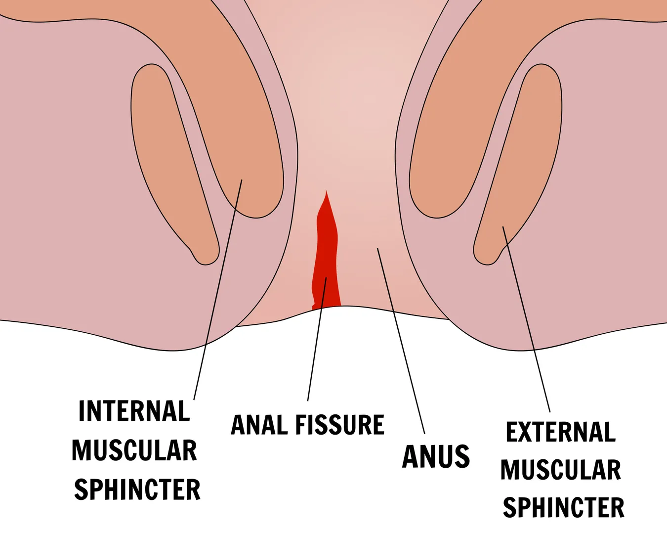 Fissure Treatment in Wakad for Pain That Disrupts Daily Routine