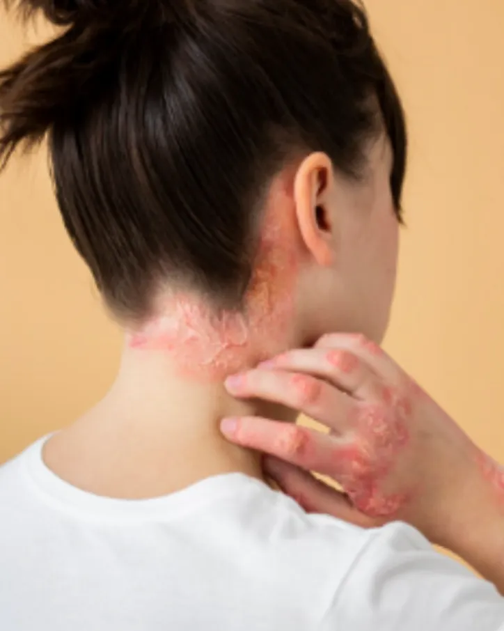 Psoriasis Treatment in Vikhroli That Focuses on Long Term Relief