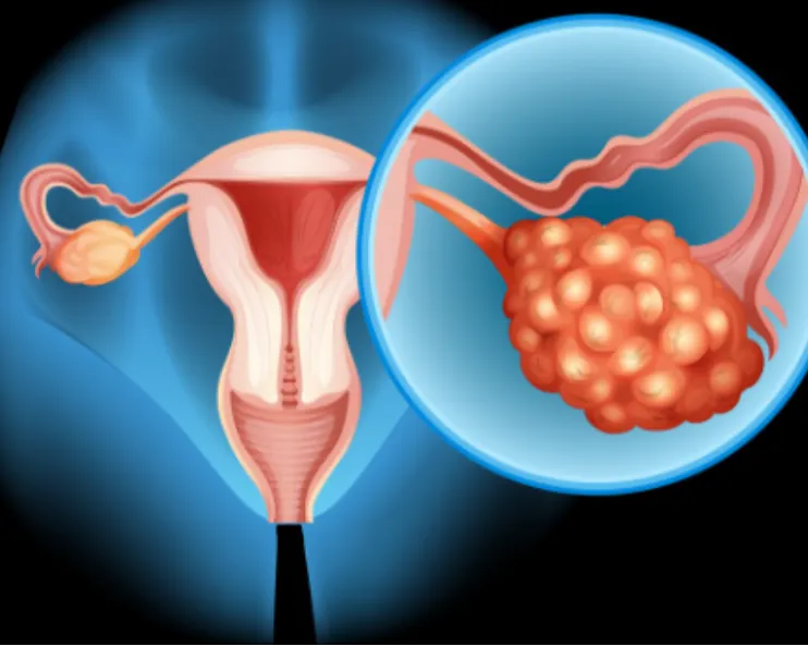 Uterine Fibroid Treatment in Mumbai – Comprehensive Care for Fibroid Management