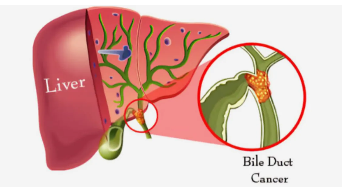 Bile Duct Cancer Treatment Specialist in PCMC – Navigating Complex Conditions with Clarity