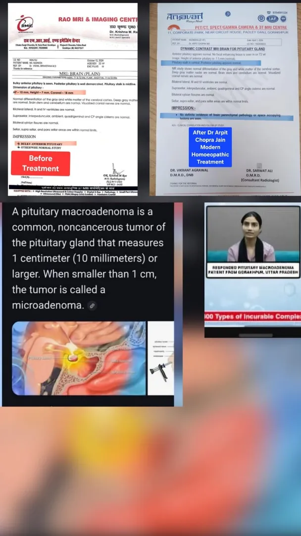 Pituitary Macroadenoma 10×7×18 MM dissolved cured & saved surgery by Dr Arpit Chopra Jain Aarogya Su...