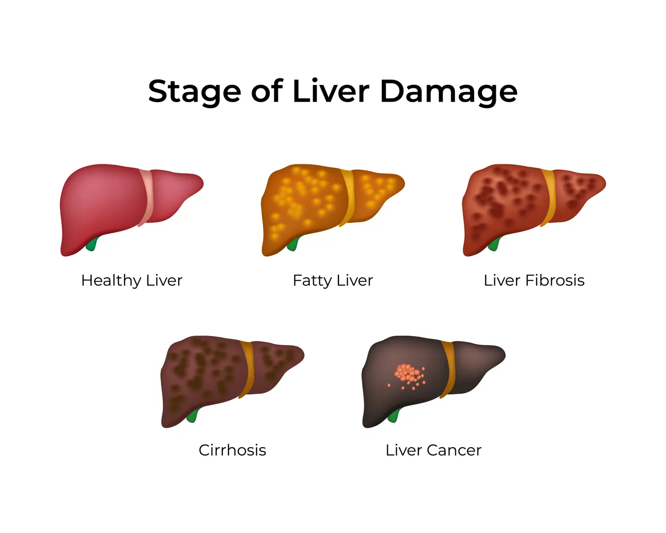 Liver Fibrosis Stages in Mumbai Understanding Progression Before It Becomes Serious