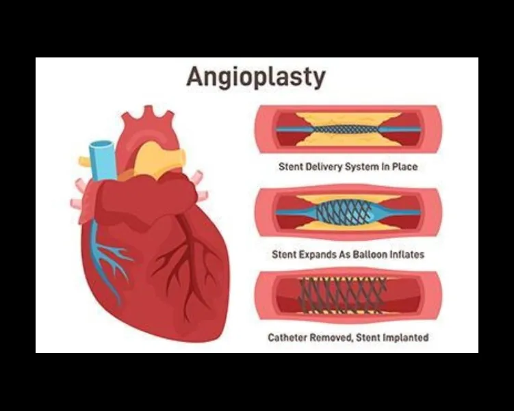 Expert care for angioplasty treatment near Baner