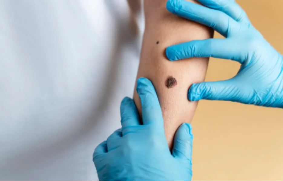Mole Warts Skin Tags Treatment in Kolshet for Safe Skin Removal