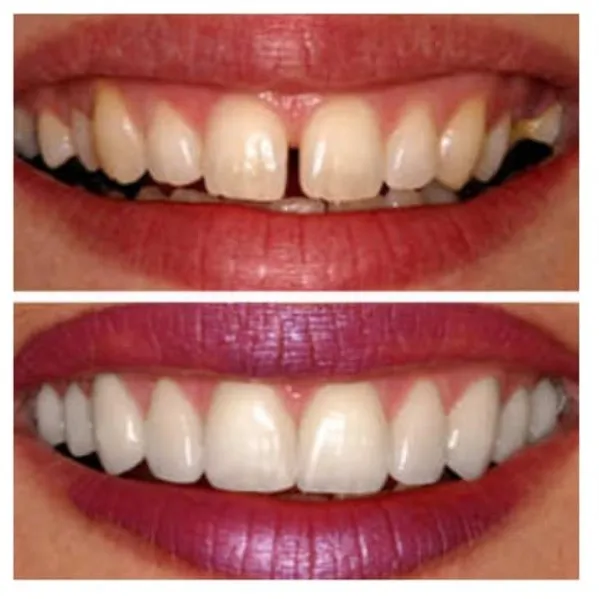 Smile Designing Treatment In Vashi