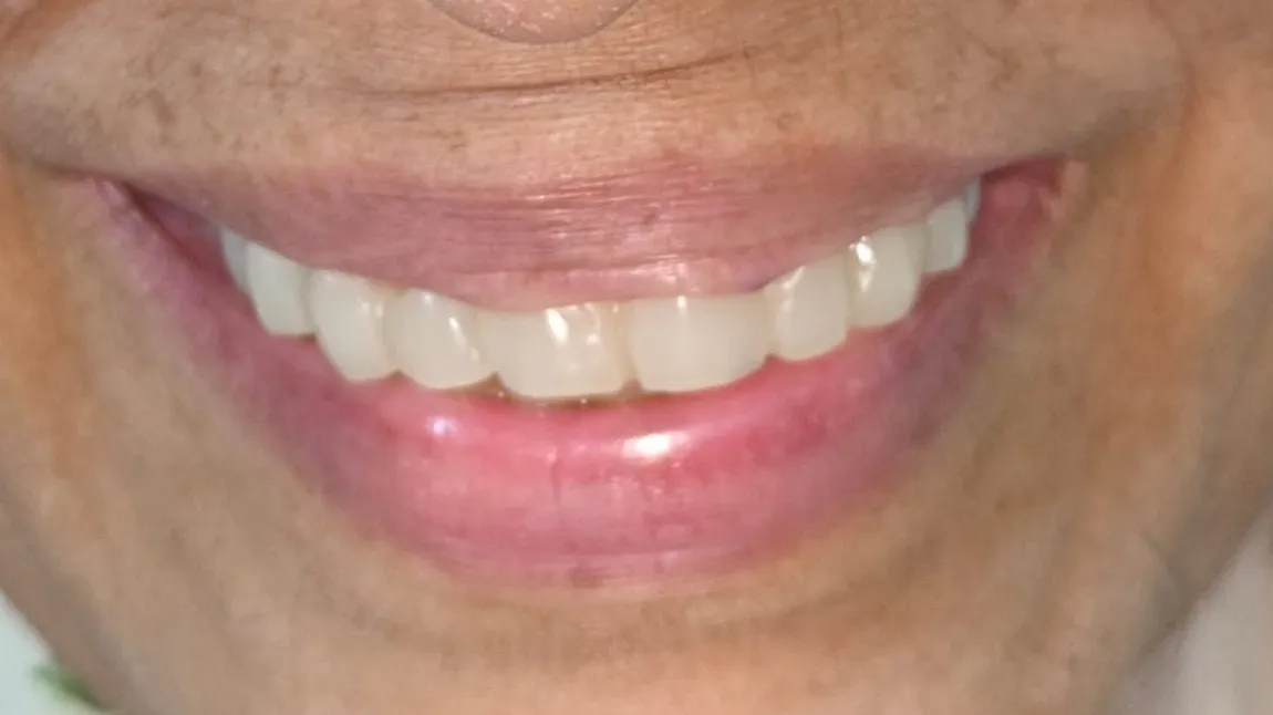 Full Mouth Rehabilitation in Mulund West Mumbai: Before, During & After Treatment Guide