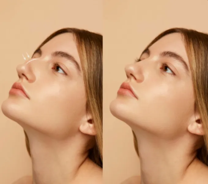 Non-Surgical Nose Reshaping in Pune for Balanced Facial Features